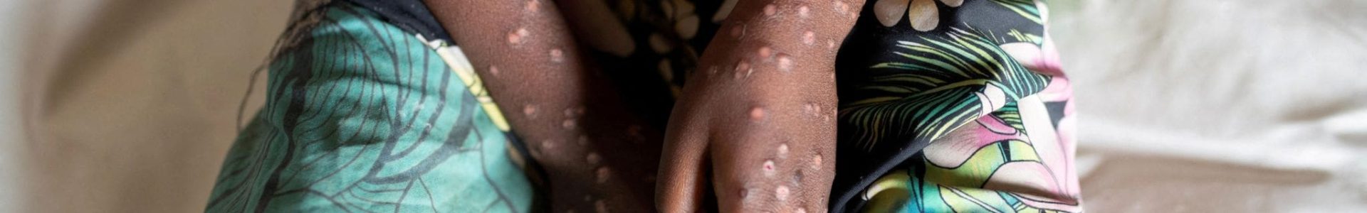 Maladie de Mpox